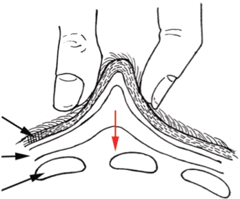 Tissue Tent Test - Figure 2. When the mobile skin and subcutaneous tissues over the rib cage are pinched and pulled away from the ribs, the layer of subcutaneous fat slips through the fingers first, in the direction of the red arrow.